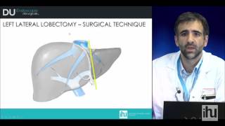 Surgical technique of hepatectomies [upl. by Edyak870]