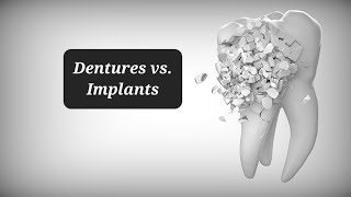 Dentures vs Dental Implants why I chose Dentures [upl. by Nino]