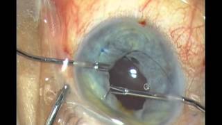 Iridoplasty for traumatic mydriasis with new iris forceps from Geuder [upl. by Uzziel]