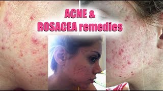 HOW TO GET RID OF ACNE AND ROSACEA  Pershii [upl. by Enyalaj886]