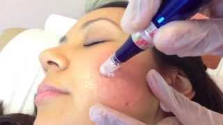 Micro Needling SkinPen for acne scarring [upl. by Gibun]