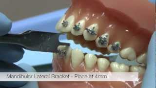 American Orthodontics Alexander LTS Brackets  Bracket Placement Video [upl. by Cletus84]