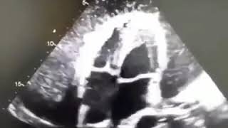 Constrictive Pericarditis with tamponade  Echo Clip  The Echo Channel [upl. by Castera482]