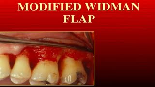 Periodontal Surgery Modified Widman Flap surgicalprocedure dentalsurgery dentistry [upl. by Eetnuahs]