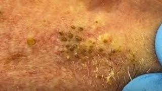 The Euphoria of Blackheads Removing  Relaxing01 [upl. by Harrat]