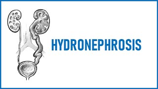 Hydronephrosis Lecture [upl. by Ahsahtan805]