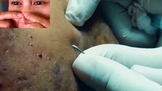 AMAZING Needle Extractions Blackheads amp Comedones Macro Older Skin [upl. by Lerner]