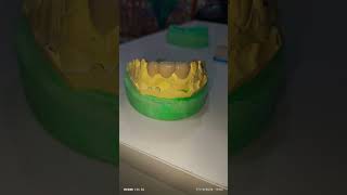 dentaltreatment magicbydentist dentist zirconiumcrowns [upl. by Mercer]