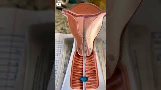 Copper IUD  Insertion of Copper t  Class 10  Biology  Barrier Method [upl. by Ennoid853]