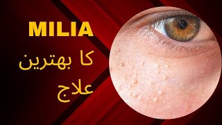 Milia Treatment and Causes  Milia Under Eye Treatment  Milia Removal Best cream Ahmedmedicalcare [upl. by Acalia]