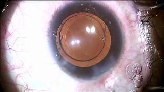 3 Piece Intraocular Lens Insertion [upl. by Emyam]