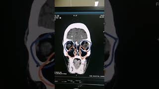 Farhr Syndrome  Syndrome of Head  Calcific densities seen on CT  Dr Green Side  Medical Imaging [upl. by Dame]