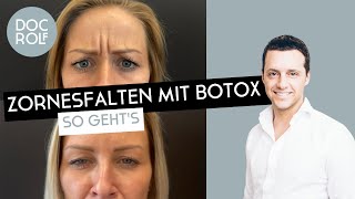 ZORNESFALTE mit BOTOX behandeln – darauf muss man achten Dr Rolf Bartsch [upl. by Spaulding]