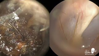 157  Severe Ear Wax Extraction From Difficult Twisty Ear using the WAXscope®️ [upl. by Fanchon]