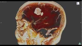 Brain Tumor 3D MRI：脳腫瘍を造影してみた [upl. by Tnecnev]