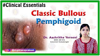 Classic bullous pemphigoid Clinical essentials Dr Aashritha yerneni [upl. by Tami407]