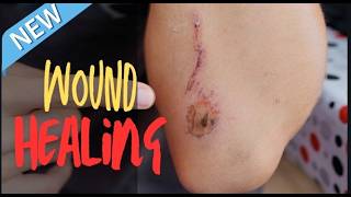 How WOUND HEALS woundhealing regenerativemedicine regeneration [upl. by Ennayoj962]