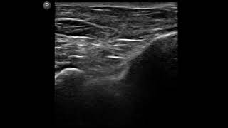 Ankle Ultrasound Tibiotalar Ankle Joint Injection [upl. by Eadmund]