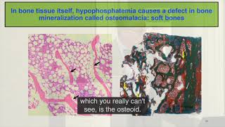 The Symposium on Hypophosphatemia Clinical Overview [upl. by Cibis100]