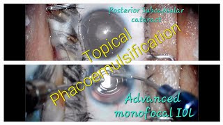 Posterior subcapsular cataract capsule polishing and advanced monofocal IOL [upl. by Ki]