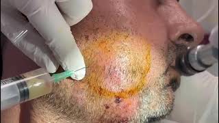 Odontogenic infections abscess [upl. by Paschasia]