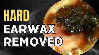 SOLID Hard Earwax Removed After Weeks [upl. by Naniac]