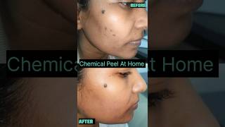 Chemical peel For Acne Scars At Home skincare peeling acnescars [upl. by Reema]