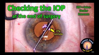 Checking the IOP at the end of cataract surgery intraocular pressure [upl. by Barbey315]