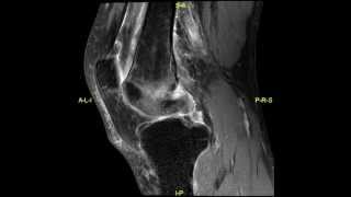 Bilateral SONK  complete MRI examination [upl. by Reifnnej]