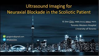 Ultrasound Imaging for Neuraxial Blockade  Lumbar Puncture in Scoliosis [upl. by Ranip]