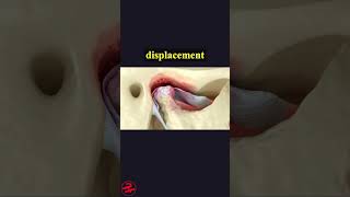 Temporomandibular Joints Arthritis And Dislocated Articular Disc health wellness shorts [upl. by Sly]