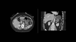 Gastrointestinal Stromal Tumor [upl. by Pavior]