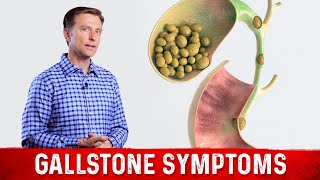 Gallstone Symptoms and Causes Explained – DrBerg on Gallbladder Stone Removal [upl. by Colb752]