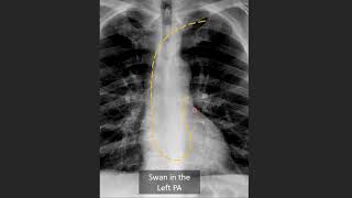 Swan Ganz Catheter Positioning on CXR [upl. by Shaefer508]