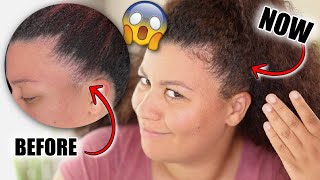 Unbelievable hair growth in just 30 DAYS 😱 My edges grew back with this ALLNATURAL product [upl. by Wanonah]