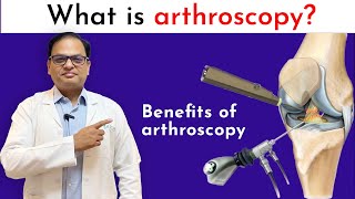 Benefits of Arthroscopic surgery [upl. by Azarcon545]