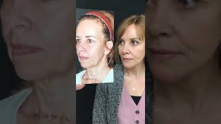 AMAZING amp NATURAL FACELIFT result Facelift Face lift Dr Nabil Fanous Montreal [upl. by Ydneh232]