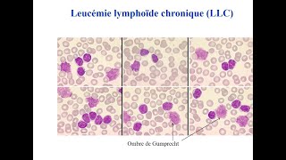 LLC  cours socle DES hématologie du 19 avril 2022 [upl. by Aneed907]