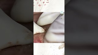 Big Cystic Acne Blackheads Extraction Blackheads amp Milia Whiteheads Removal Pimple Popping [upl. by Dorison]