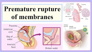 premature rupture of membranes [upl. by Nahgiem]