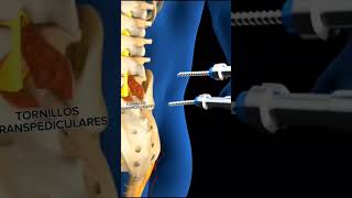 DESCOMPRESIÓN de columna y TORNILLOS Transpediculares [upl. by Shoemaker]