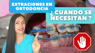 Extraciones en ortodonciabrackets 7 Razones para hacerlas [upl. by Bruni190]