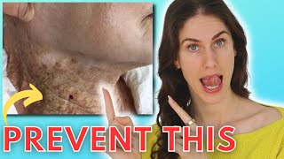 ☀️ 9 SHOCKING Things Sun Does To Your Skin Actinic Keratosis Rhinophyma ￼Solar Elastosis amp More [upl. by Uba513]