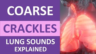 Coarse Crackles Lung Sounds Audio Causes Auscultation Nursing NCLEX Review [upl. by Eirrot]