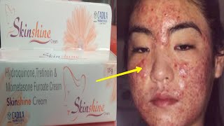 Skin Shine CREAM SIDE EFFECTS के कारण  Reason of SIDE EFFECTS  How to Remove side effects  Hindi [upl. by Annahaj]