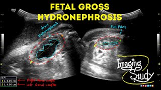 Fetal Unilateral Hydronephrosis  Ultrasound  Anomaly  Case 44 [upl. by Abil]