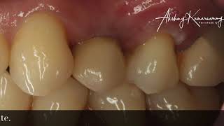 Maxillary Premolar implant  Start to finish [upl. by Hamirak]