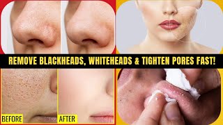 Herbal Remedies to Remove Blackheads Whiteheads amp Tighten Pores Fast [upl. by Tacy]