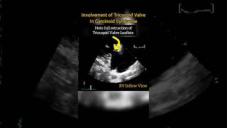 Involvement of Tricuspid Valve in Carcinoid Syndrome echocardiography [upl. by Accebor339]