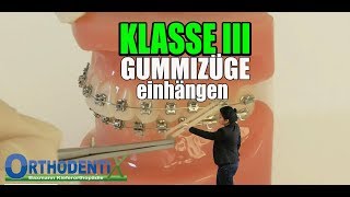 Gummizüge Klasse III festsitzende Zahnspange Kieferorthopädie  Orthodentix [upl. by Enogitna98]